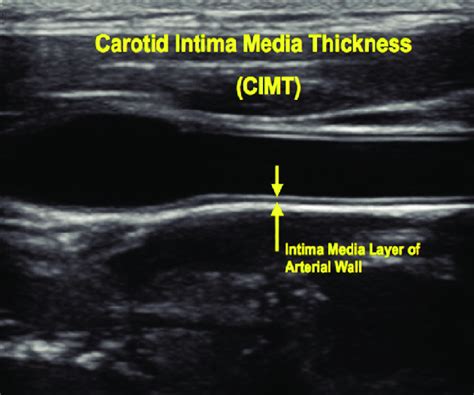 carotid intima media thickness measurement|normal carotid intima media thickness.